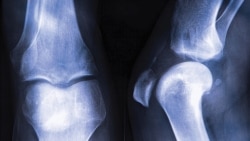 Quiz - Your Bones Are Alive! Learn How to Keep Them Strong.