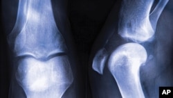 Osteoporosis in leg join