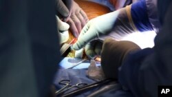 Hirurzi izvode prvu na svijetu genetski modificiranu transplantaciju bubrega svinje u živog čovjeka u Opštoj bolnici Massachusetts, u Bostonu, 16. marta 2024. 