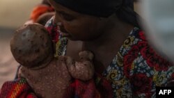 A woman dries her baby suffering from a severe form of mpox at the Kavumu hospital, 30 km north of Bukavu in eastern Democratic Republic of Congo, Aug. 24, 2024. 