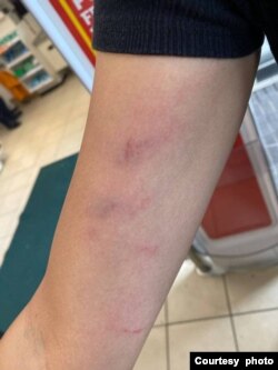 其中一名被袭击的香港人事后展示伤势（照片来源：@carmenkamanlau, Carmen Lau 刘珈汶推特帐号）