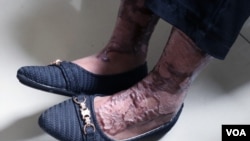 Kepada VOA, Siti Khotimah memperlihatkan salah satu luka yang membekas akibat siraman air panas majikannya. (VOA/Indra Yoga)