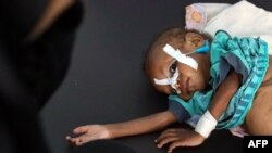 FILE - A malnourished child receives treatment at a malnutrition center in Yemen's third city of Taez, July 3, 2021. 