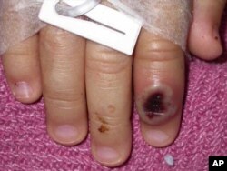 Cacar monyet yang menyerang seorang jari anak kecil. (Foto: AP)