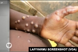 WHO Ta Ce An Samu Cutar Kyandar Biri A Kasashe 12 - Monkey Pox