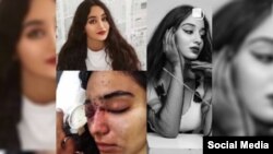 غزل رنجکش بینایی چشم راستش را بر اثر اصابت گلوله ساچمه‌ای از دست داد (عکس از صفحه اینستاگرام غزل رنجکش)