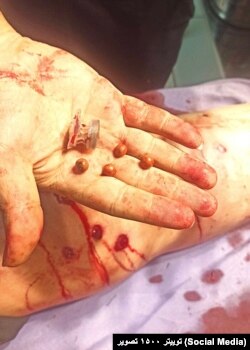 اعتراضات سراسری ایران، گلوله‌های خارج شده از بدن یک معترض، شنبه ۱۴ آبان ۱۴۰۱