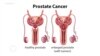 በወንዶች መራቢያ አካላት ላይ ጉዳት የሚያደርሰው ፕሮስቴት ካንሰር 