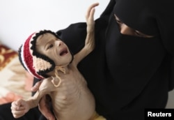 FILE - A woman holds her malnourished child at a feeding center at al-Sabyeen hospital in Yemen's capital, Sanaa.