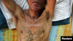 Salah satu orang dengan AIDS di Thailand.