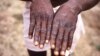 WHO Considers Declaring Monkeypox a Global Health Emergency