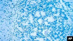 Genetska terapija za rak kod djece