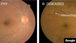 Google deep learning methods are used to detect diabetic eye disease. The image on the left is a healthy retina, while the one on the right shows signs of diabetic disease. (Google AI)