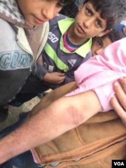 Weeks after the bombings, locals near suspected chemical attacks say they are still developing symptoms, like this man's rash, in Mosul, Iraq, March 22, 2017. (H. Murdock/VOA)
