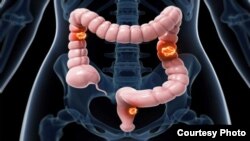 Cancer colorectal