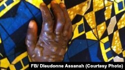 Monkey pox patient in RCA