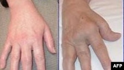 Tìm hiểu về bệnh phong thấp