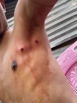 VOA Burmese journalist Htet Aung Khant shows the wound marks left by rubber bullets when he was hit while documenting protests in Mandalay, a city in Myanmar, March 3, 2021. (Htet Aung Khant/VOA Burmese)