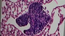 Belgian Researchers Discover Way to Block Cancer Metastasis