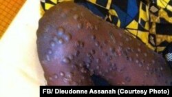 Cas de variole du singe en République Centrafricaine.