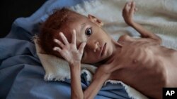 ملل متحد گزارش داده است که یمن بلندترین میزان سوتغذیه را در بین کشورهای عربی دارد