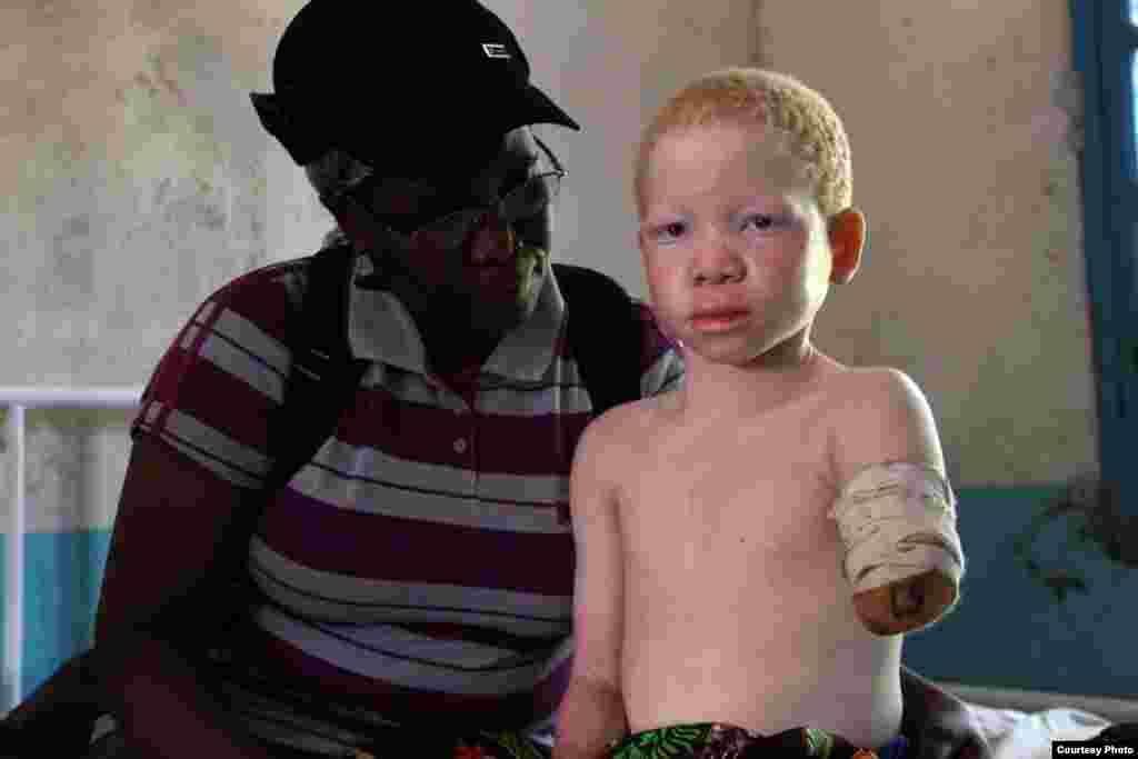 On February 15, two men chopped off the arm of 10-year-old Mwigulu Matonange in Msia village, Rukwa region, Tanzania. (Under The Same Sun) 