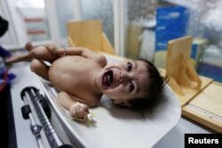 A malnourished girl cries as she is being weighed at a malnutrition treatment center in Sanaa, Yemen, Oct. 31, 2016.