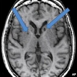 Silent Strokes Tied to Memory Loss Among Older Adults