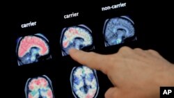 FILE - In this Aug. 14, 2018 file photo, a doctor looks at a PET brain scan at the Banner Alzheimers Institute in Phoenix. Two experimental drugs failed to prevent or slow mental decline in a study of people who are virtually destined to develop…