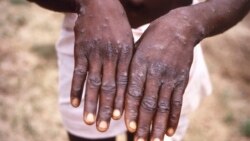 SML: Numéro vert epesami mpo bakoni ba Monkeypox bakimi basato na Kinshasa