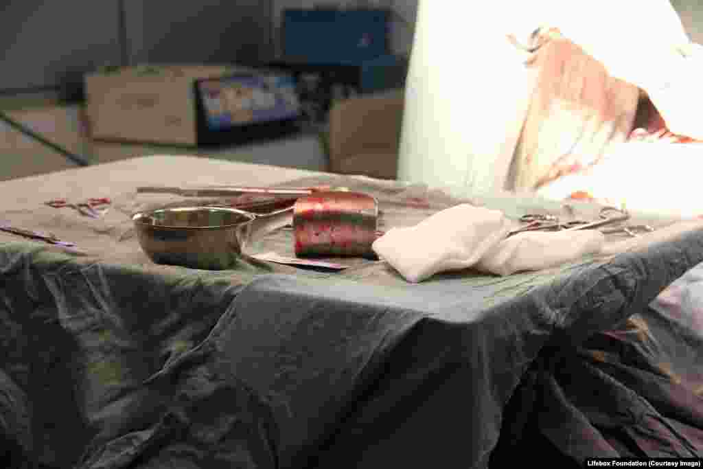 Bloody implements on the sterile table during emergency Caesarean section.