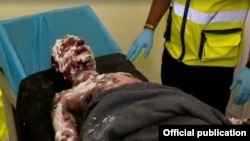 ერთ-ერთი გადარჩენილი მეშახტე, რომელმაც ძლიერი დამწვრობა მიიღო