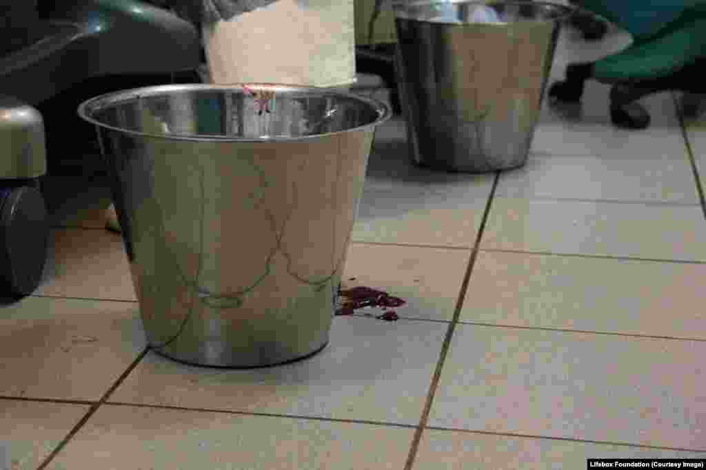 Blood on floor, bucket for counting swabs, during emergency Caesarean section.