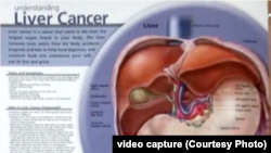 آرشیف: یافته تحقیق تازه نشان می دهد که افراد اضافه وزن در مقایسه با افراد با وزن معمول دو برابر بیشتر معروض به مرض جگر استند