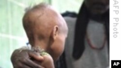 Many Severely Malnourished Children in Ethiopia at Risk Of Death