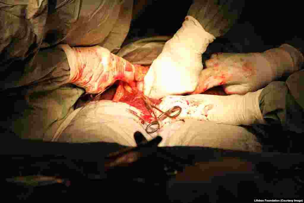 Hands inside the body cavity.