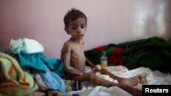A malnourished boy sits on a bed at a malnutrition treatment center in Sanaa, Yemen, Oct. 30, 2016. 