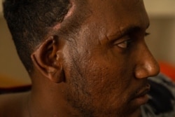 Nigusse Tadele, 29, woke up in a clinic after a bombing. He lost his toes and part of his ear, pictured in Axum, Ethiopia, June 10, 2021. (Yan Boechat/VOA)