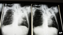 X-rays from a tuberculosis patient at A. G. Holley Hospital in Lantana, Florida, Dec. 2009 (file photo).