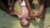 Alternative Therapy Soothes Brazil Babies Suffering Defects Linked to Zika