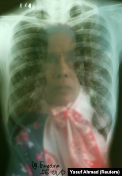 Seorang perempuan suspek Tuberkulosis (TBC) melihat hasil rontgennya di sebuah rumah sakit TBC di Makassar, Sulawesi Selatan, 23 Oktober 2009. (Foto: REUTERS/Yusuf Ahmad)