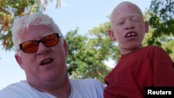Un père et un enfant albinos.