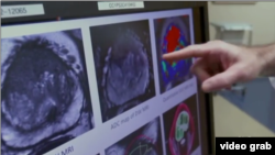 Sama seperti dengan mamografi digunakan untuk mendeteksi kanker payudara, ada banyak kontroversi tentang tes digunakan untuk mendiagnosa kanker prostat. Sebuah studi baru menunjukkan dokter sekarang mungkin memiliki cara yang lebih dapat diandalkan untuk mendiagnosa kanker prostat untuk pasien berisiko tinggi. (Foto: Videograb).