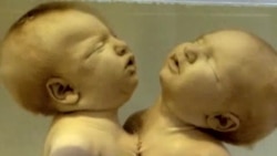 150 yil oldin ochilgan salomatlik va tibbiyot muzeyida/US Medical Museum