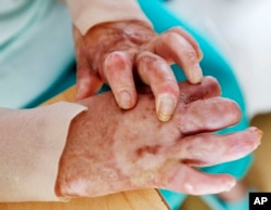 17-year-old Yazidi girl, Yasmin, shows her hands at her home in Germany after escaping the clutches of Islamic State. She was so traumatized by her captivity that she poured gasoline on herself and set it alight. Two years later, she’s being treated in Germany, photo taken July 28, 2016.