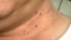 Skin tags