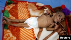 Fatima Abdullah Hassan, un an, souffrant de malnutrition sévère, dans un centre de traitement nutritionnel à Hodeida, Yémen, 20 décembre 2017.