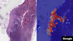 The left sample shows a tissue slide containing lymph nodes. The right samples shows results from Google's AI-based Lymph Node Assistant analysis.