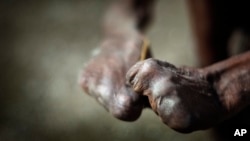 Tangan mantan penderita kusta. Badan Kesehatan Dunia (WHO) menyerukan tindakan untuk mengatasi penyakit-penyakit tropis terabaikan, salah satunya kusta, yang telah menimbulkan dampak pada sekitar 1,65 miliar orang di seluruh dunia. (Foto: AP)