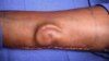 US Army Doctors 'Grows' Ear on Soldier's Arm